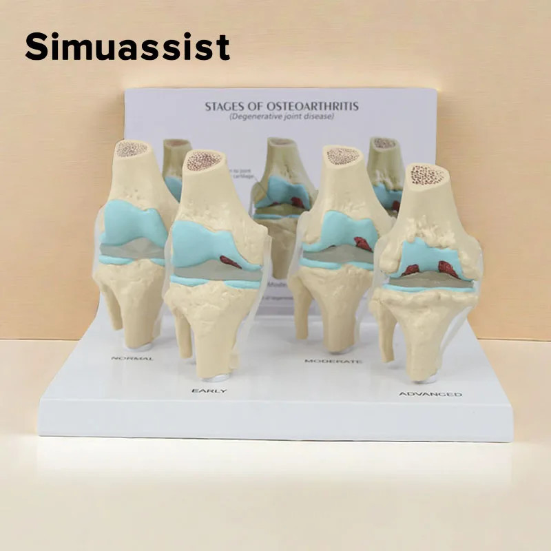 4-stage knee joint model Plastic Bone Model Pathological Knee Model ...