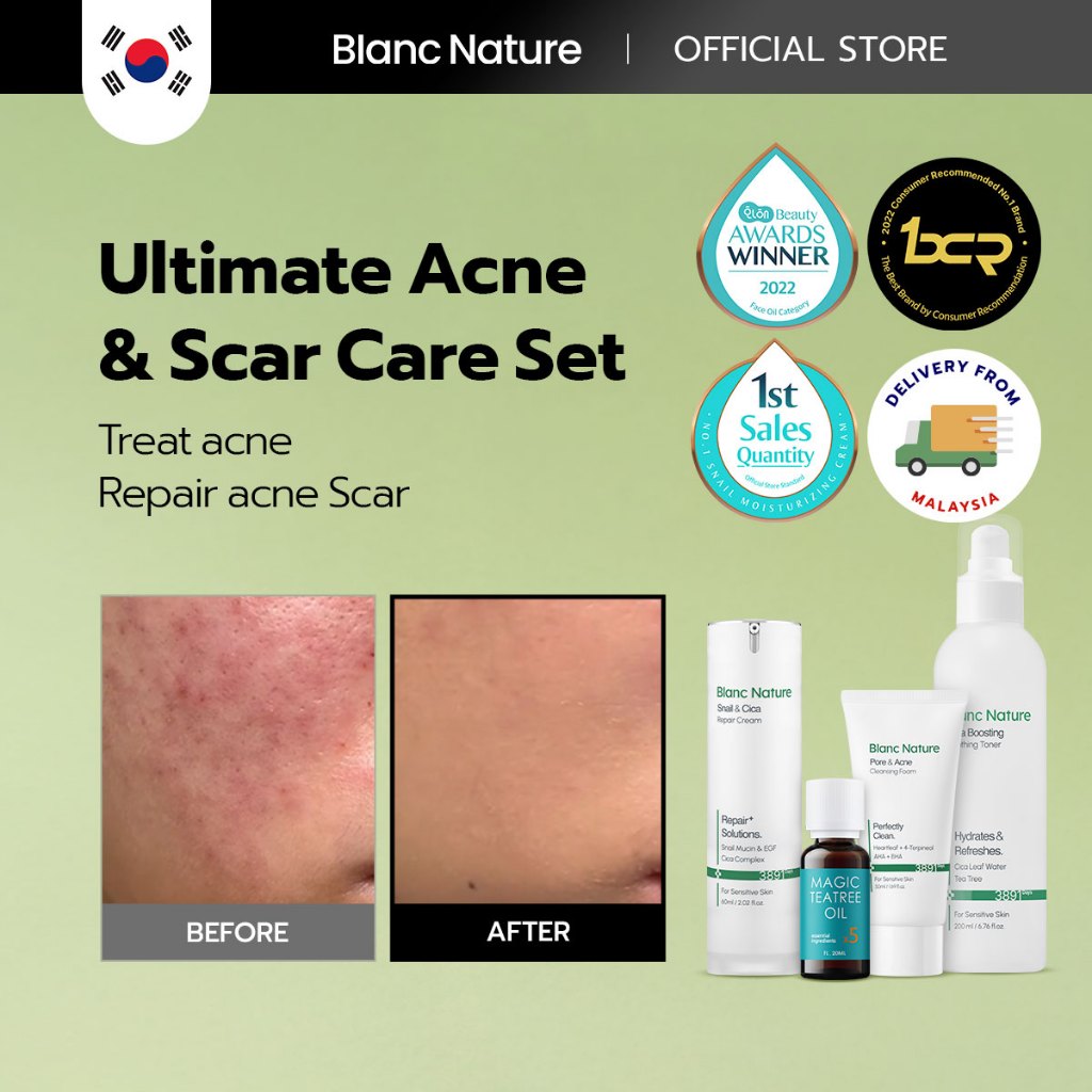 Ultimate Acne&Acne Scar Treatment Set for pimiple care (Set of 4 ...
