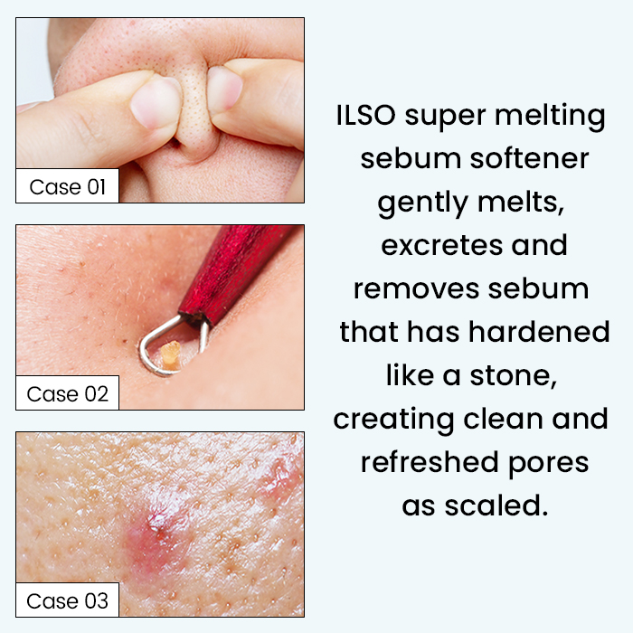 [ ilso Official ] ⭐JMIE'S PICK⭐ Super Melting Sebum Softener + Nose ...