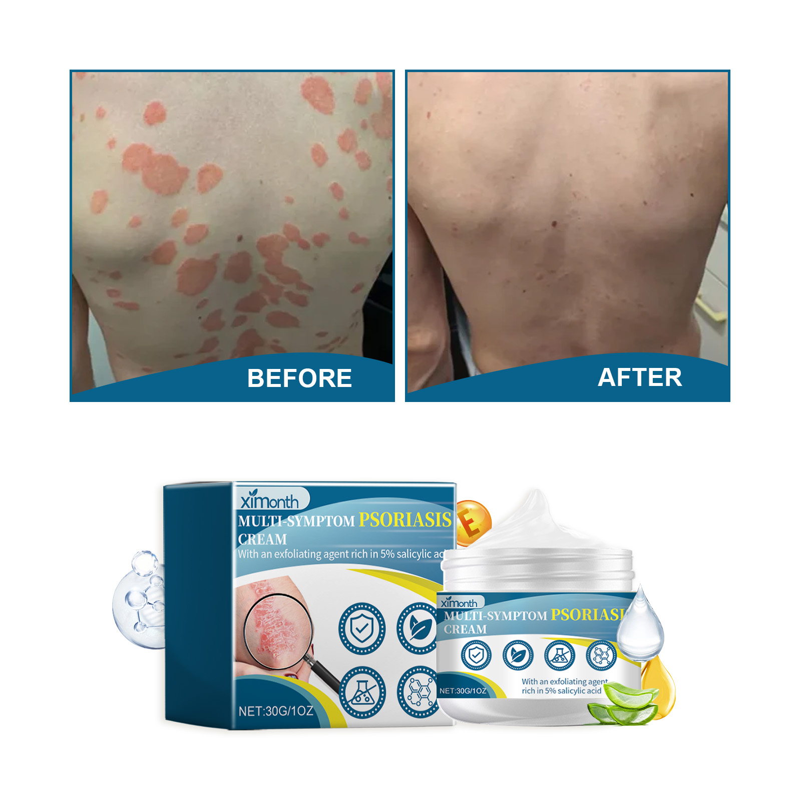 Multi-Symptom Psoriasis Ointment - Antibacterial, Anti-Itchy Cream for ...