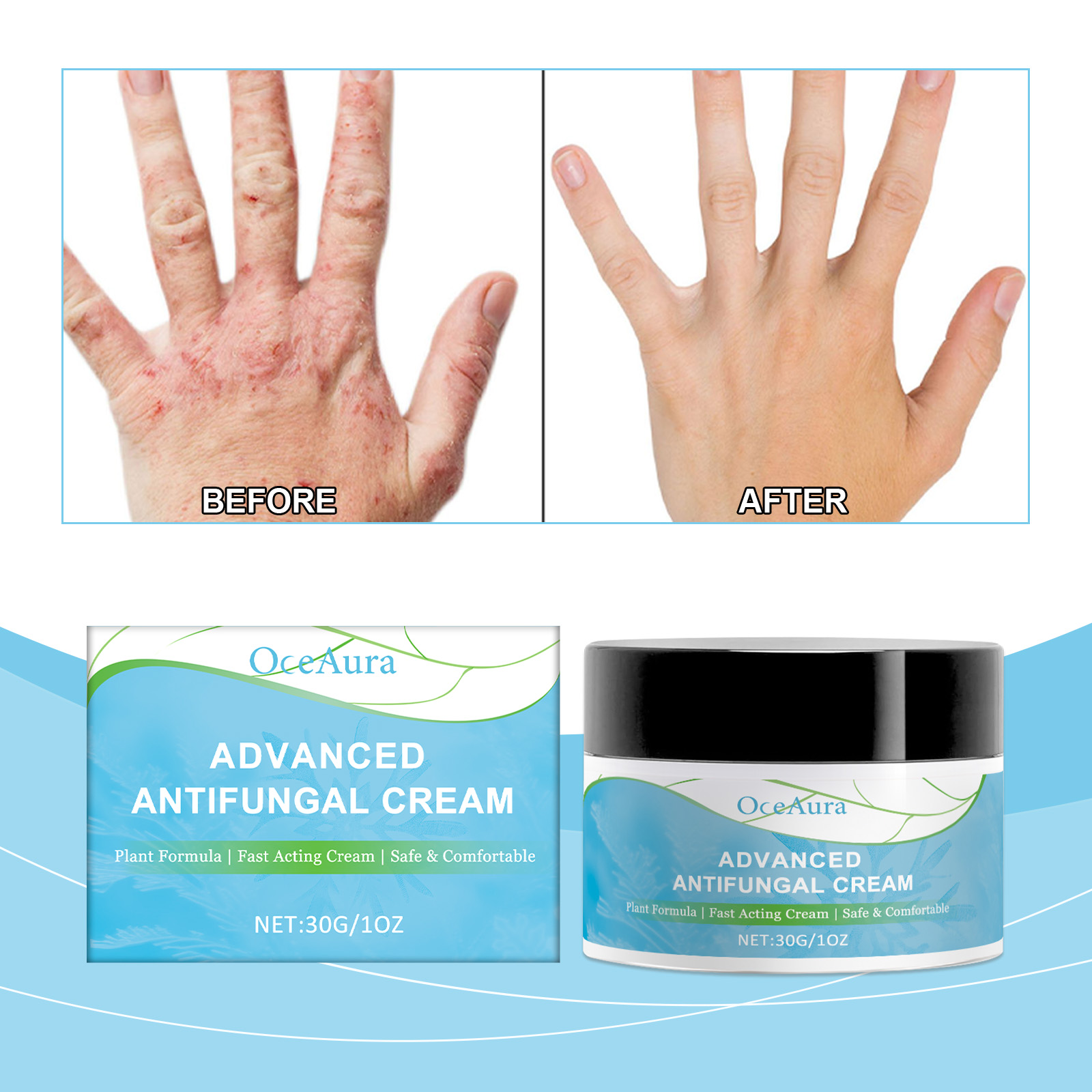 Anti Fungal Ringworm Fungisol Antifungal Psoriasis Antifungal Cream 30g ...