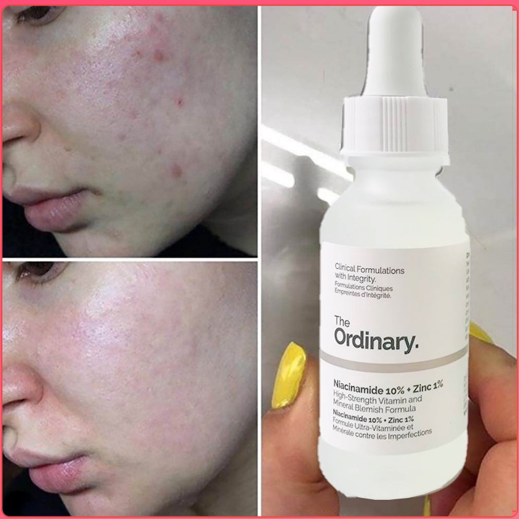 ready-stock-the-ordinary-niacinamide-10-zinc-1-whiten-skin