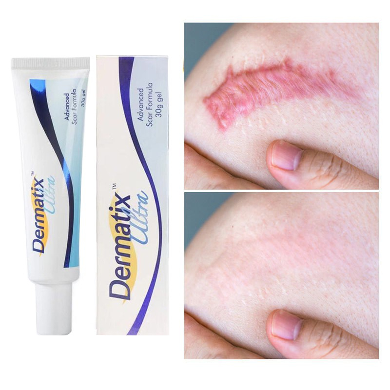 DERMATIX (Buy 1 Get 1 Free) Dertix ultra Scar Treatment Scarring Cream