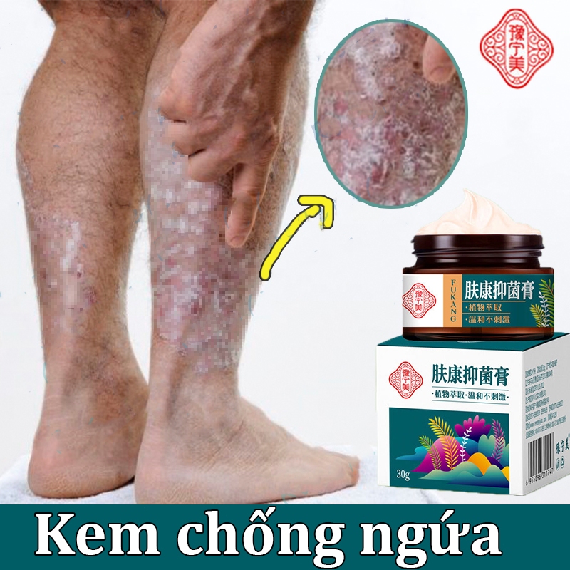 Itchy Fungal Topical Cream, Itchy Reliever Cream, Anti-Itch Cream
