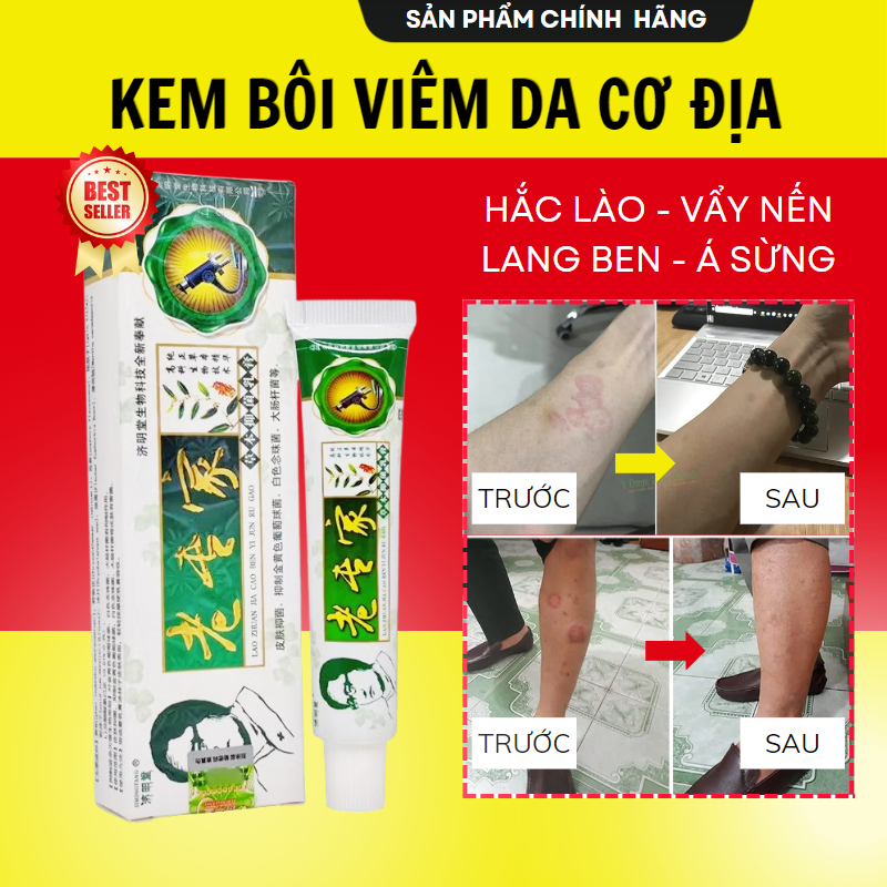 Itchy Fungus Topical Cream to Support Ringworm, Diarrhea, Psoriasis ...
