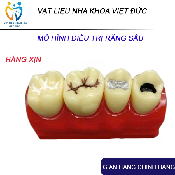 Anatomical dental model exalates tooth decay diseases, dental cavities ...