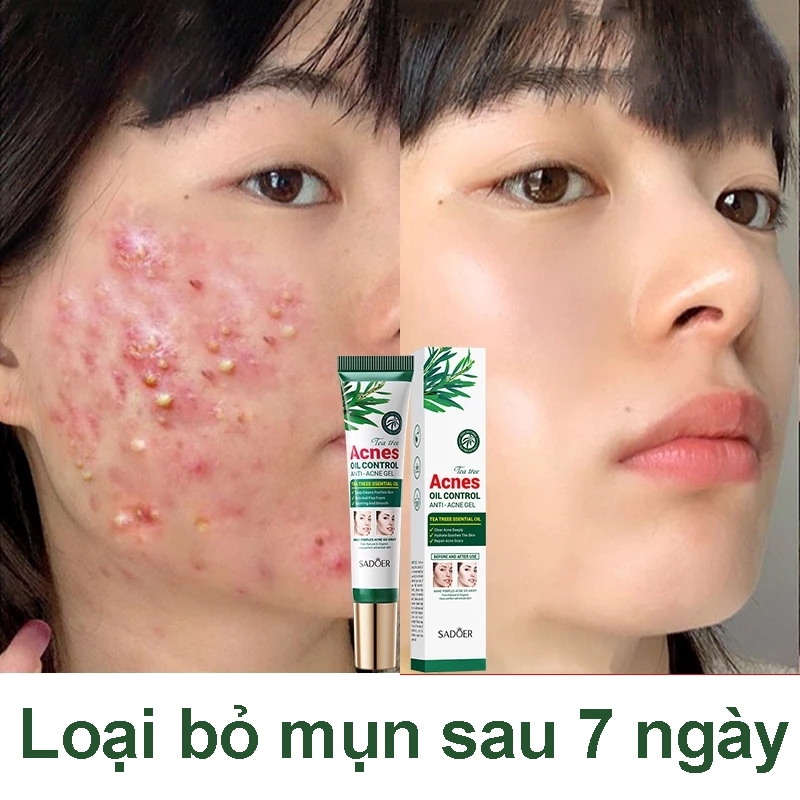 Acne removal cream, Fade acne marks, facial care, shrink pores ...
