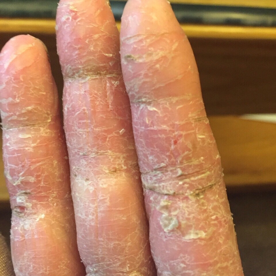 Apply to remove peeling skin on fingers, toes, palms, feet (Always ...
